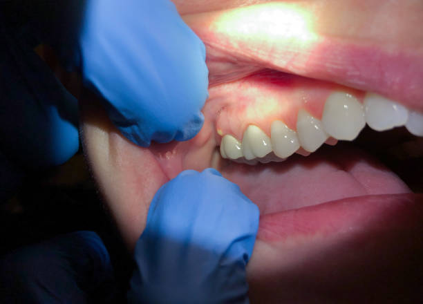 Best Emergency Dental Extractions in Timberwood Park, TX